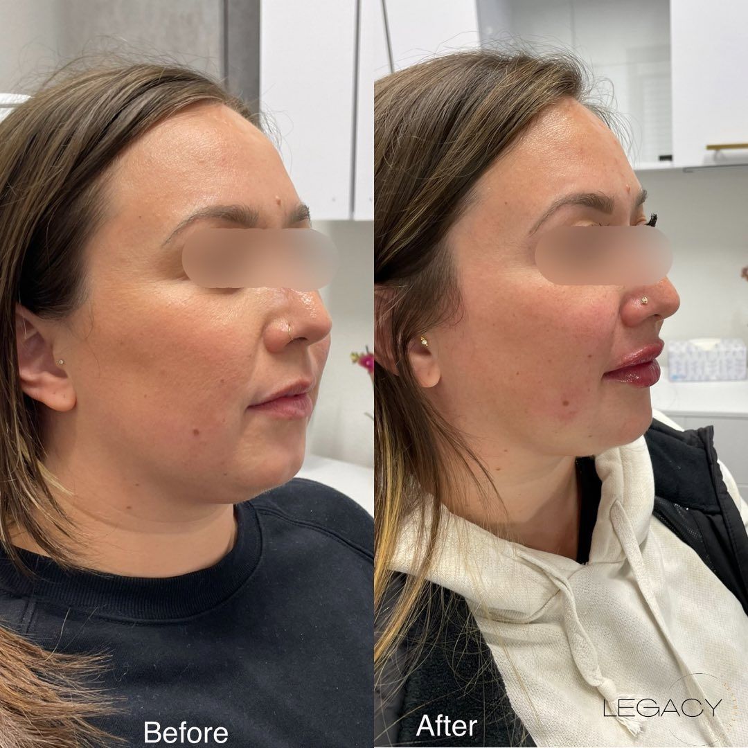 Side-by-side before-and-after profile photos of a woman in a clinic setting, showing facial changes.