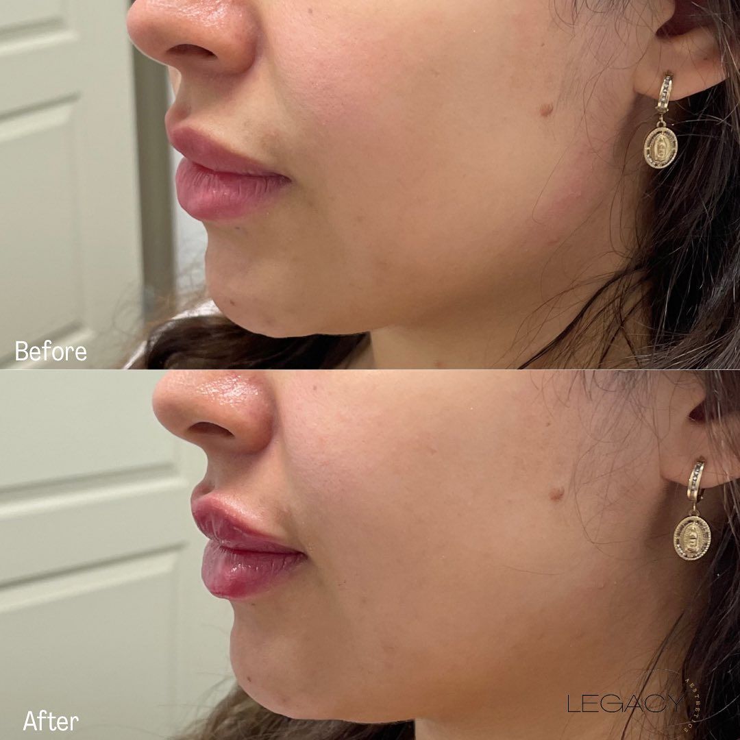 Side-by-side profile comparison showing a nose before and after cosmetic refinement.