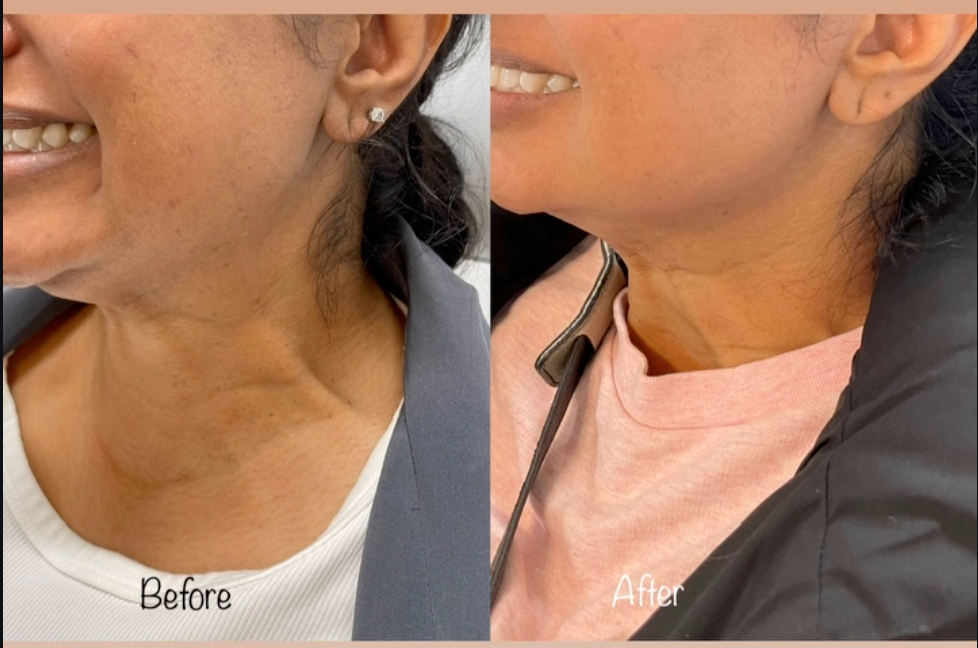 Side-by-side neck profile before and after, showing smoother skin and reduced neck lines