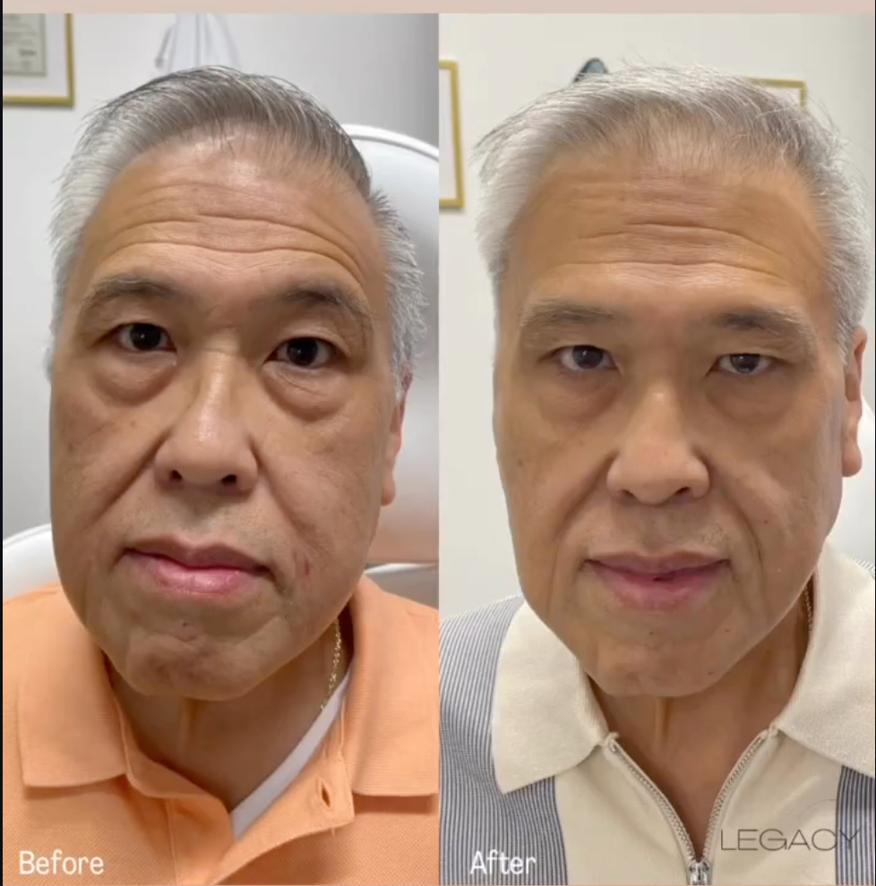 Before-and-after close-up of a man’s face in a peach polo shirt, showing lighter skin after treatment.