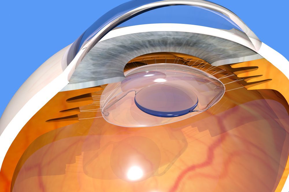 CLE - clear lens extraction