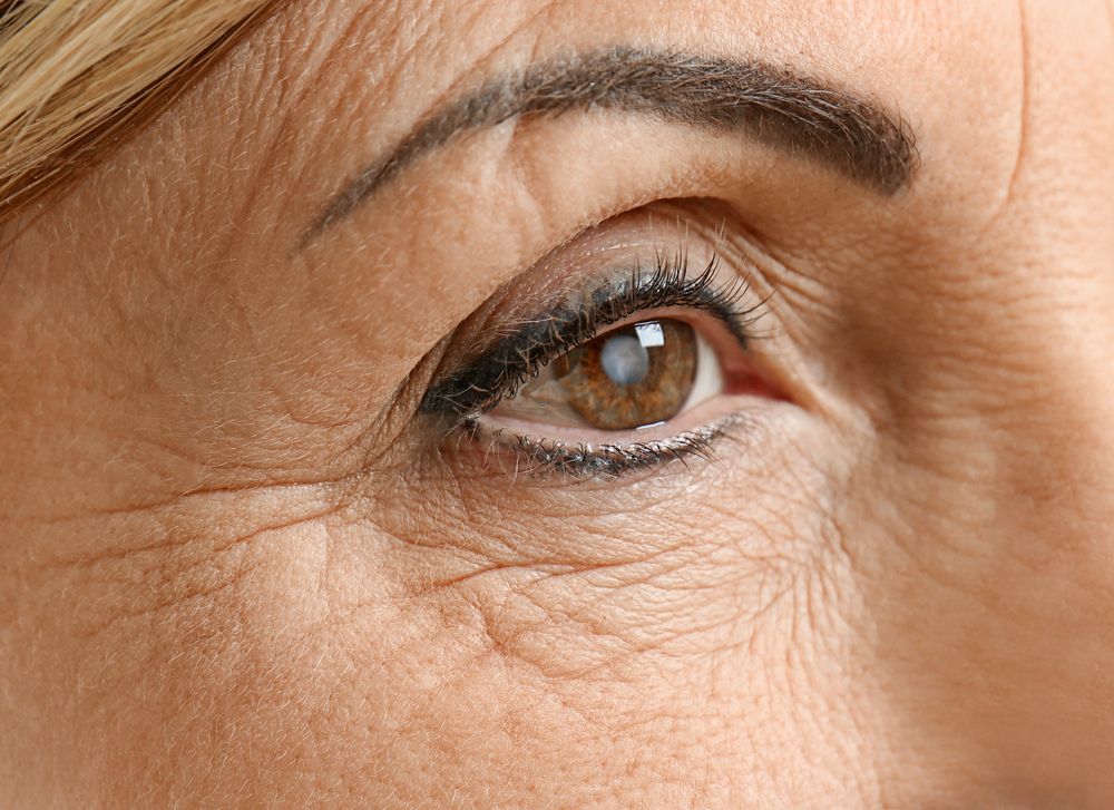 close up of eye with cataracts