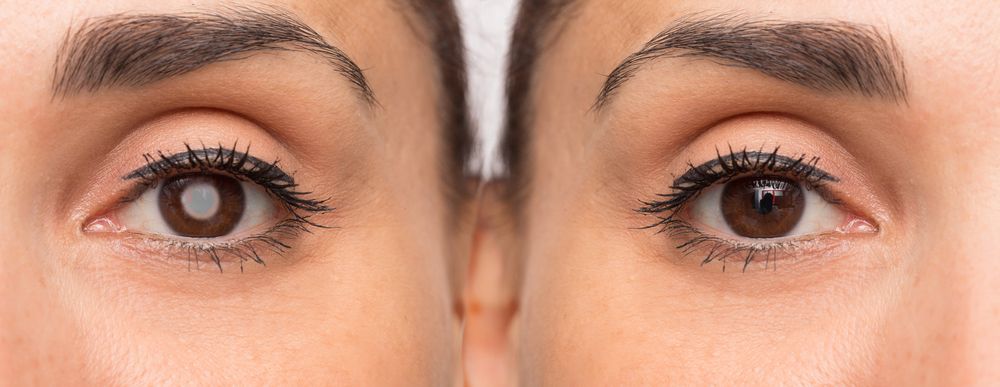 CLE - clear lens extraction