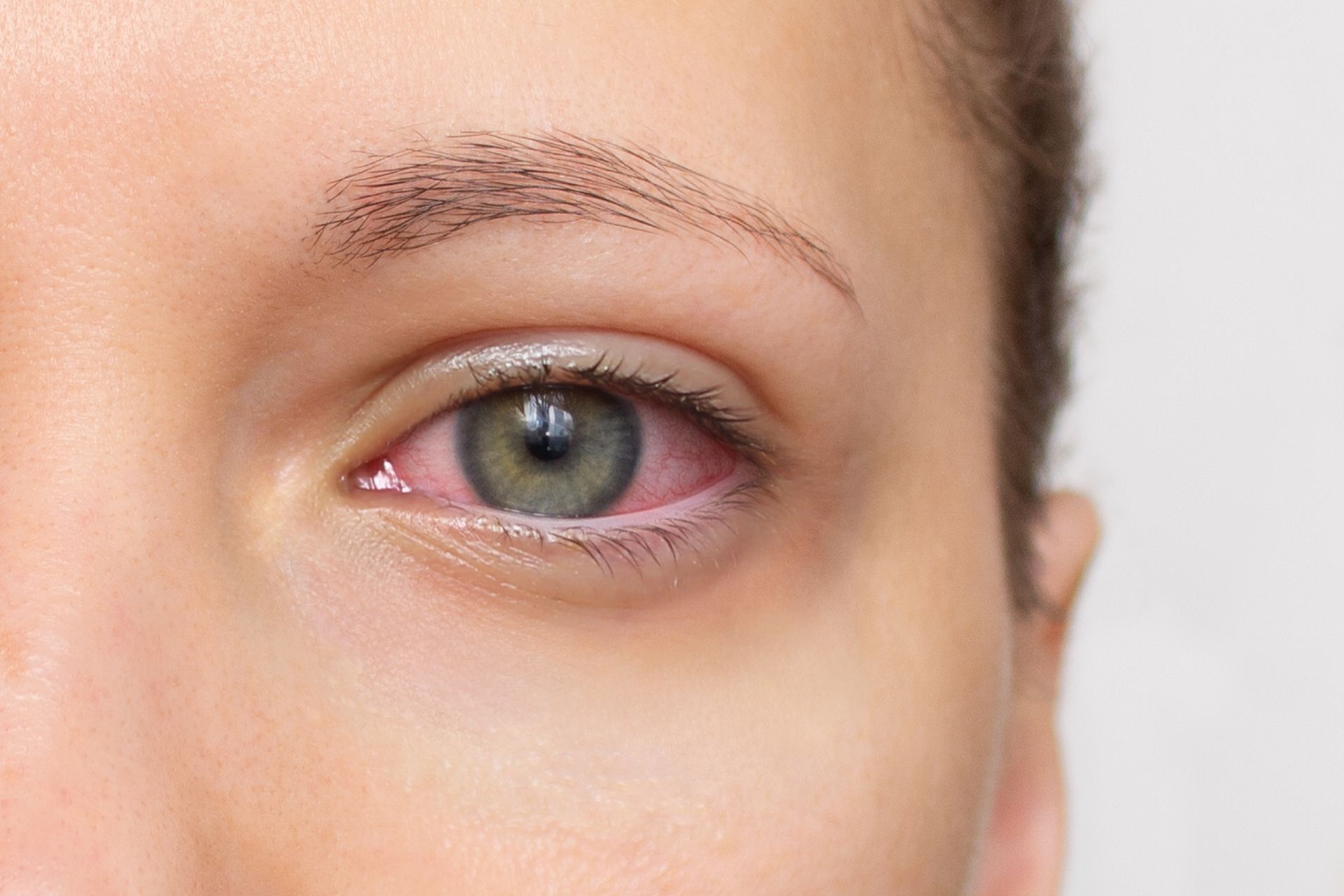 Close-up of a blue eye on a light-skinned face with a visible under-eye bruise