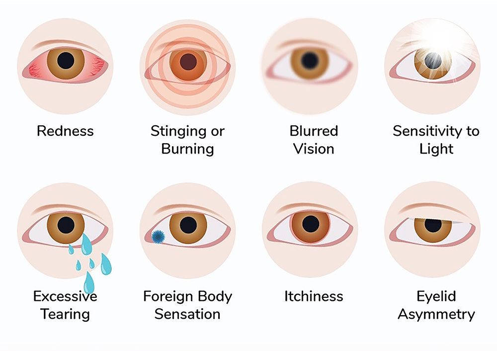 Eye symptom chart showing redness, burning, blurred vision, light sensitivity, tearing, foreign body sensation, itchiness, and eyelid asymmetry