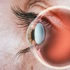 Close-up of a blue eye with a small contact lens and inset showing lens placement on the lower eyelid