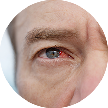 Close-up of a red, irritated eye on a person’s face