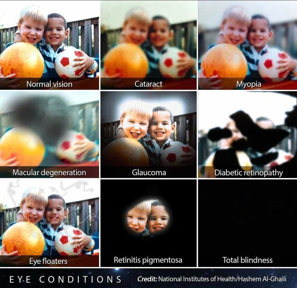 Eye conditions comparison chart showing normal vision and effects of cataract, glaucoma, and total blindness.