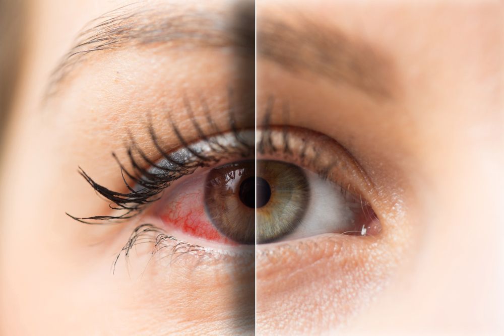 red dry eyes