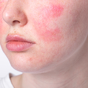 Close-up of a person’s lower face with red, irritated patches on the cheek and chin