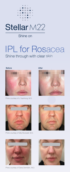 Stellar M22 IPL for Rosacea brochure showing before-and-after face treatment photos