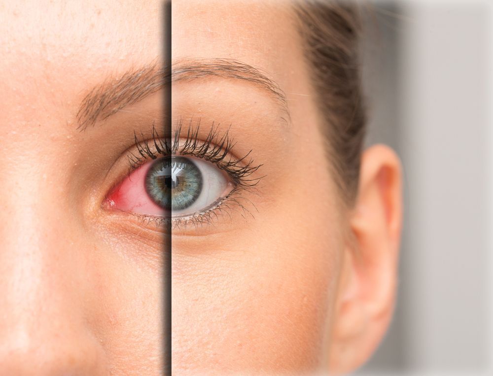 Close-up of a bloodshot eye beside a clear, healthy eye, divided by a vertical line.