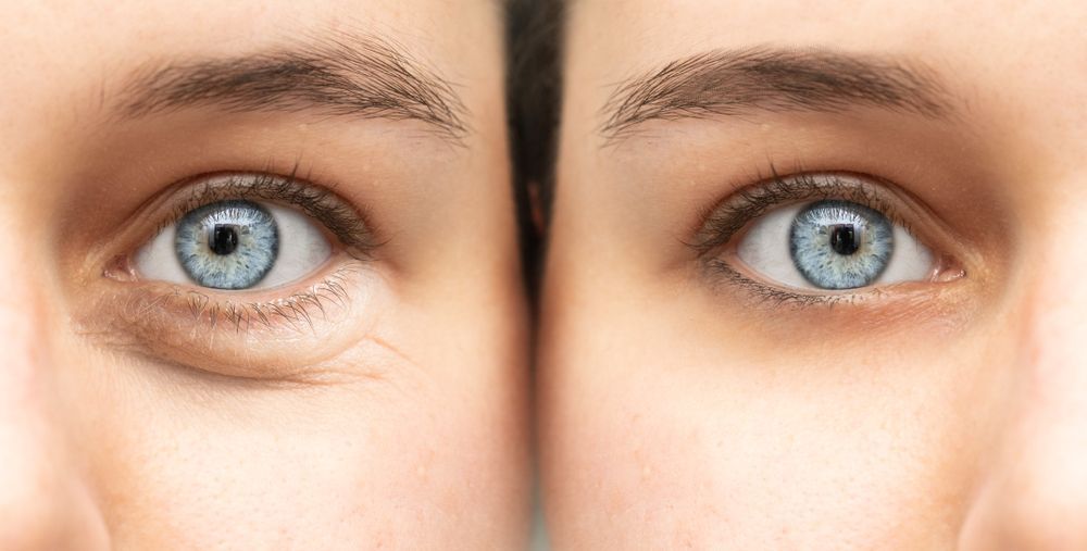 Close-up comparison of two blue eyes, one with visible under-eye wrinkles and one smoother