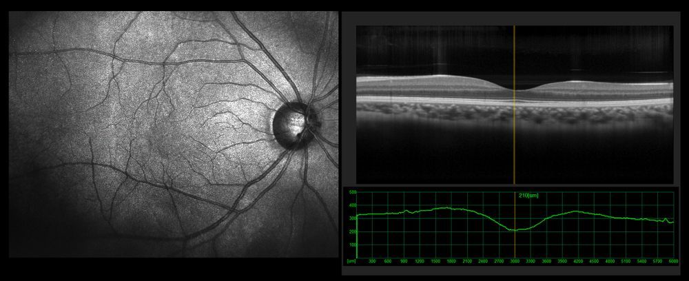 Grayscale retinal scan with optic disc, plus cross-sectional eye chart and green measurement graph
