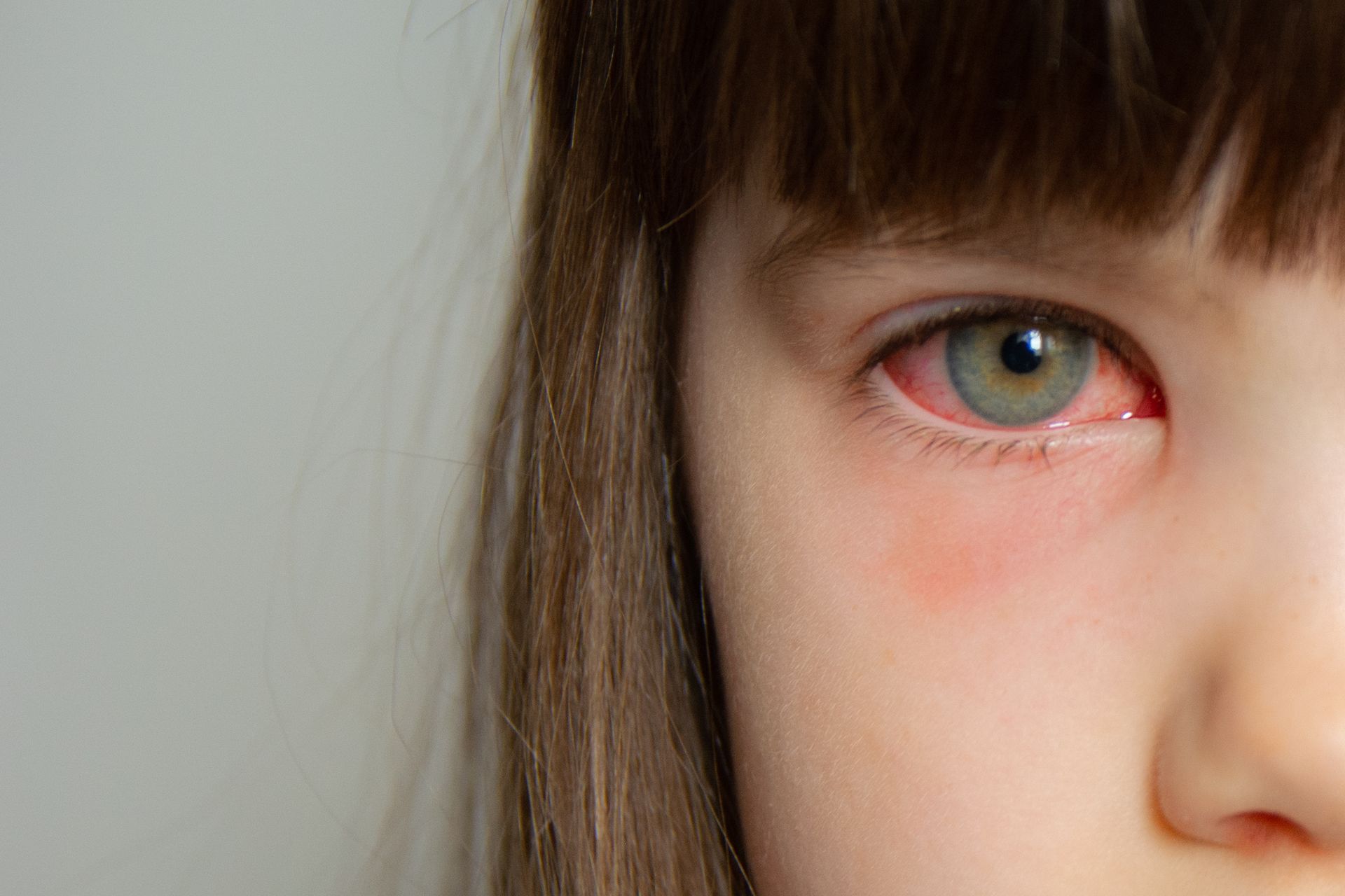 Close-up of a child's face with a red, irritated eye and straight bangs