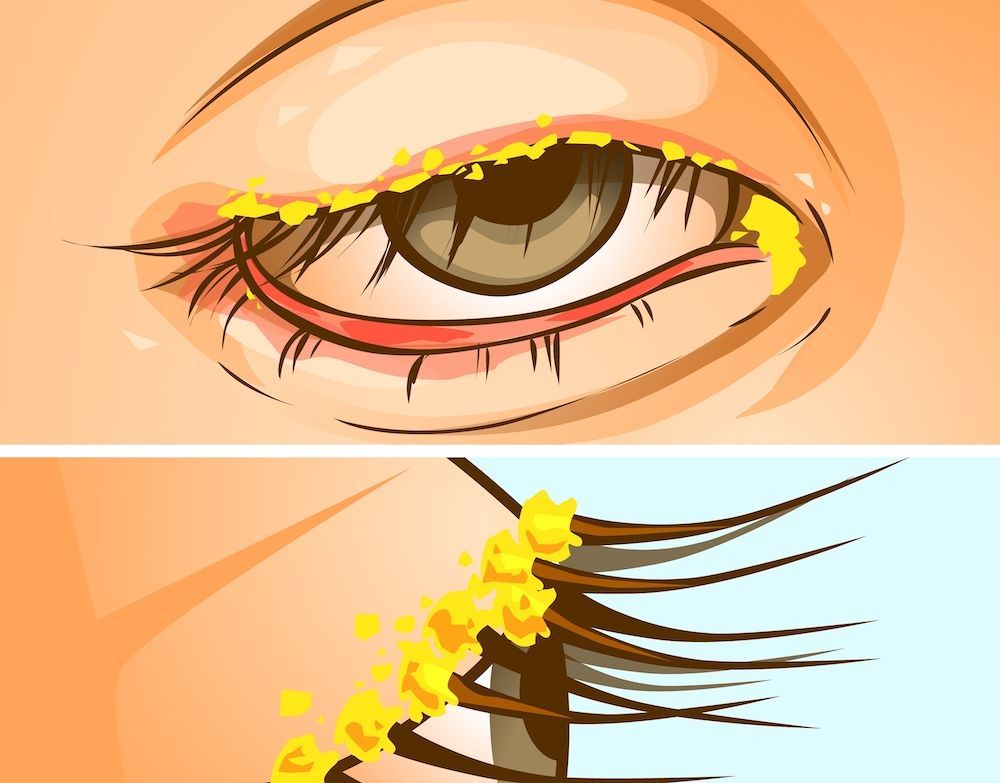 Close-up eye with yellow flakes and red irritation, showing eyelash crusting and inflammation