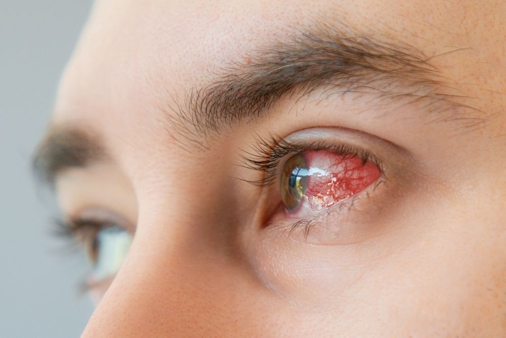 Close-up of an eye with a red, irritated inner eyelid and visible redness around it