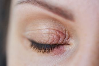 Close-up of an eye with a red, irritated inner eyelid and visible redness around it