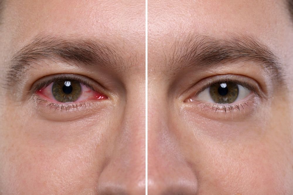 Close-up of one eye before and after treatment, showing reduced redness and irritation.