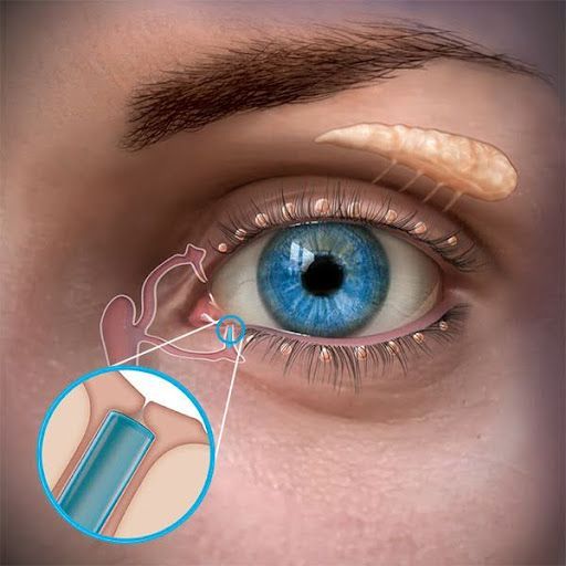 Illustration of an eye with a curved implant above it and a magnified view of an eye-dropper tip near the eyelid