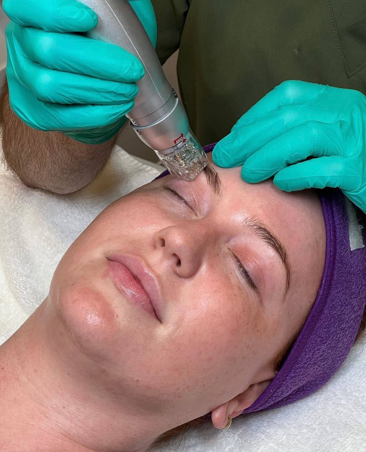 RF Microneedling
