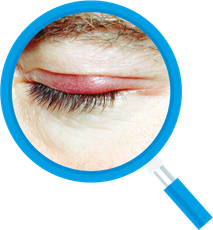 Eye with a red, swollen stye on the eyelid, magnified with a blue magnifying glass.