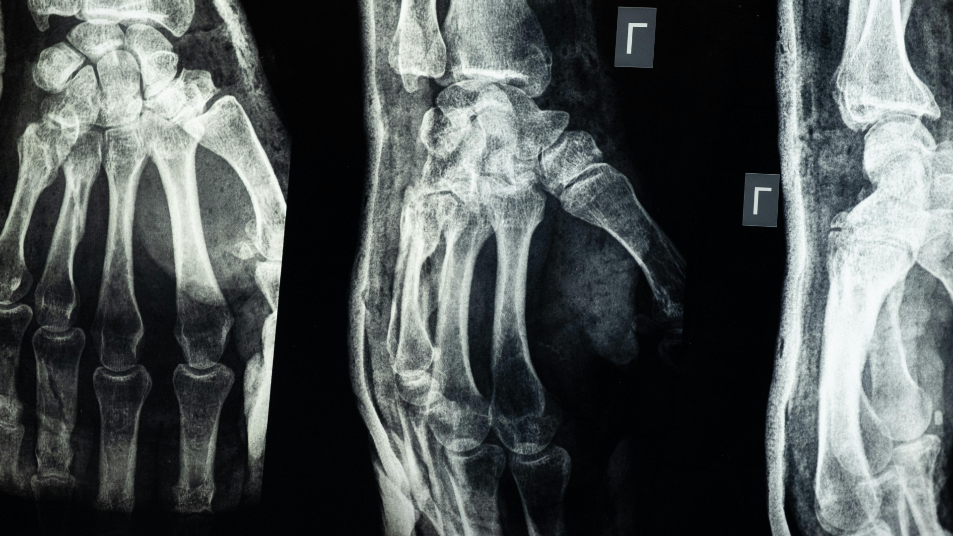 A black and white x-ray of a hand , wrist and ankle.