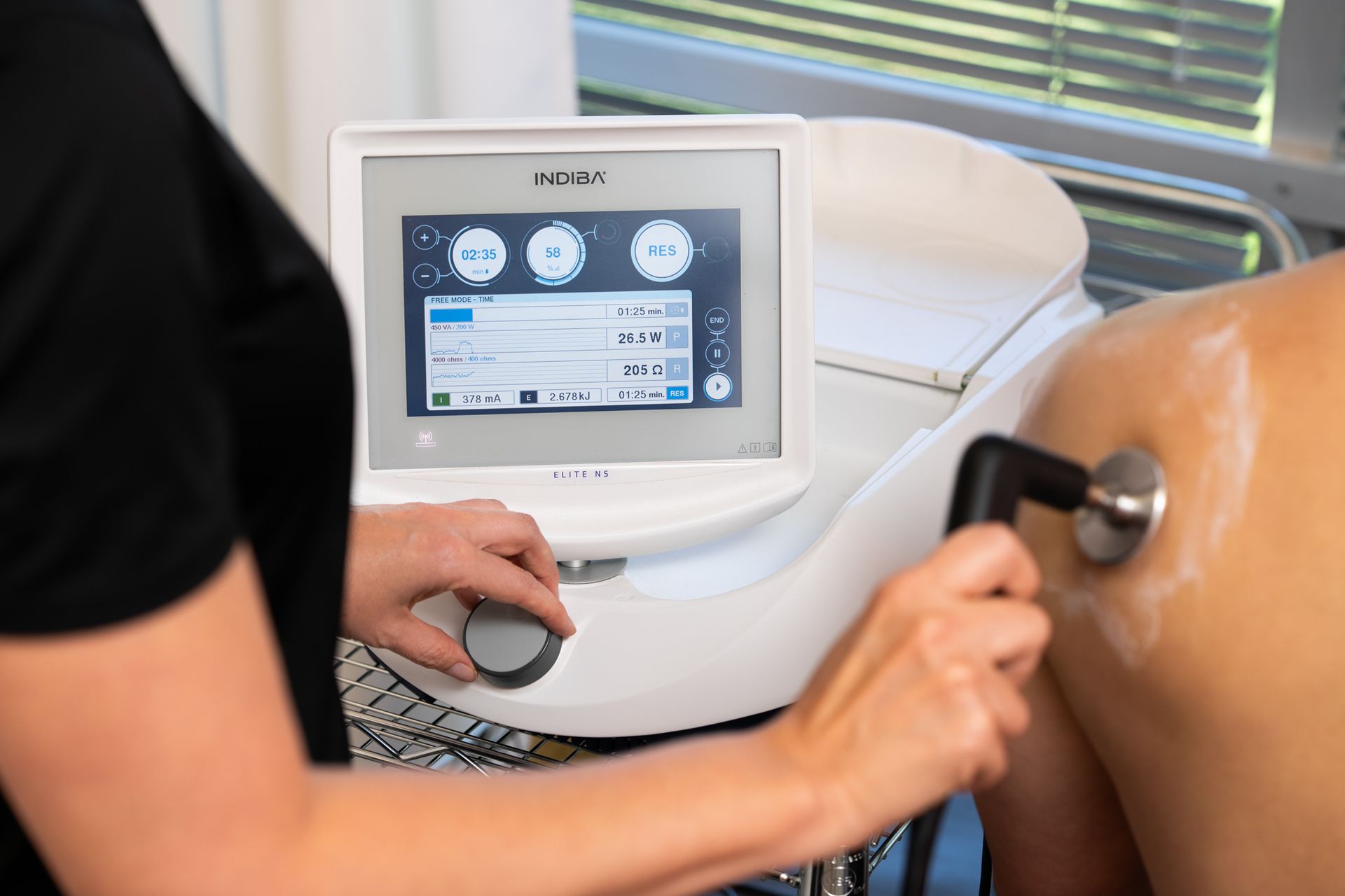 Radio Frequency treatments in Tucker & Decatur, Georgia