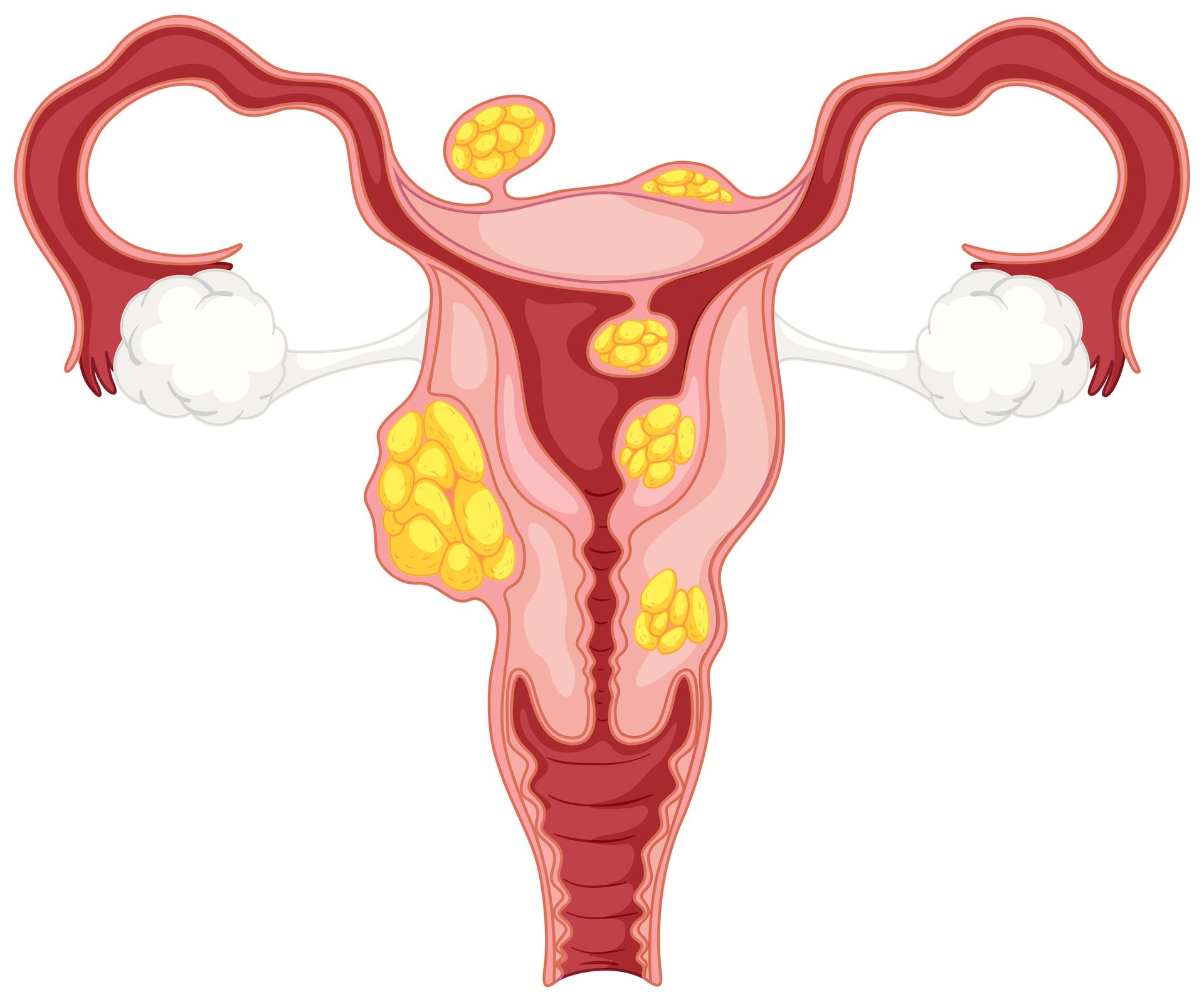 Diagram of uterus with fallopian tubes and ovaries, showing yellow cyst-like growths