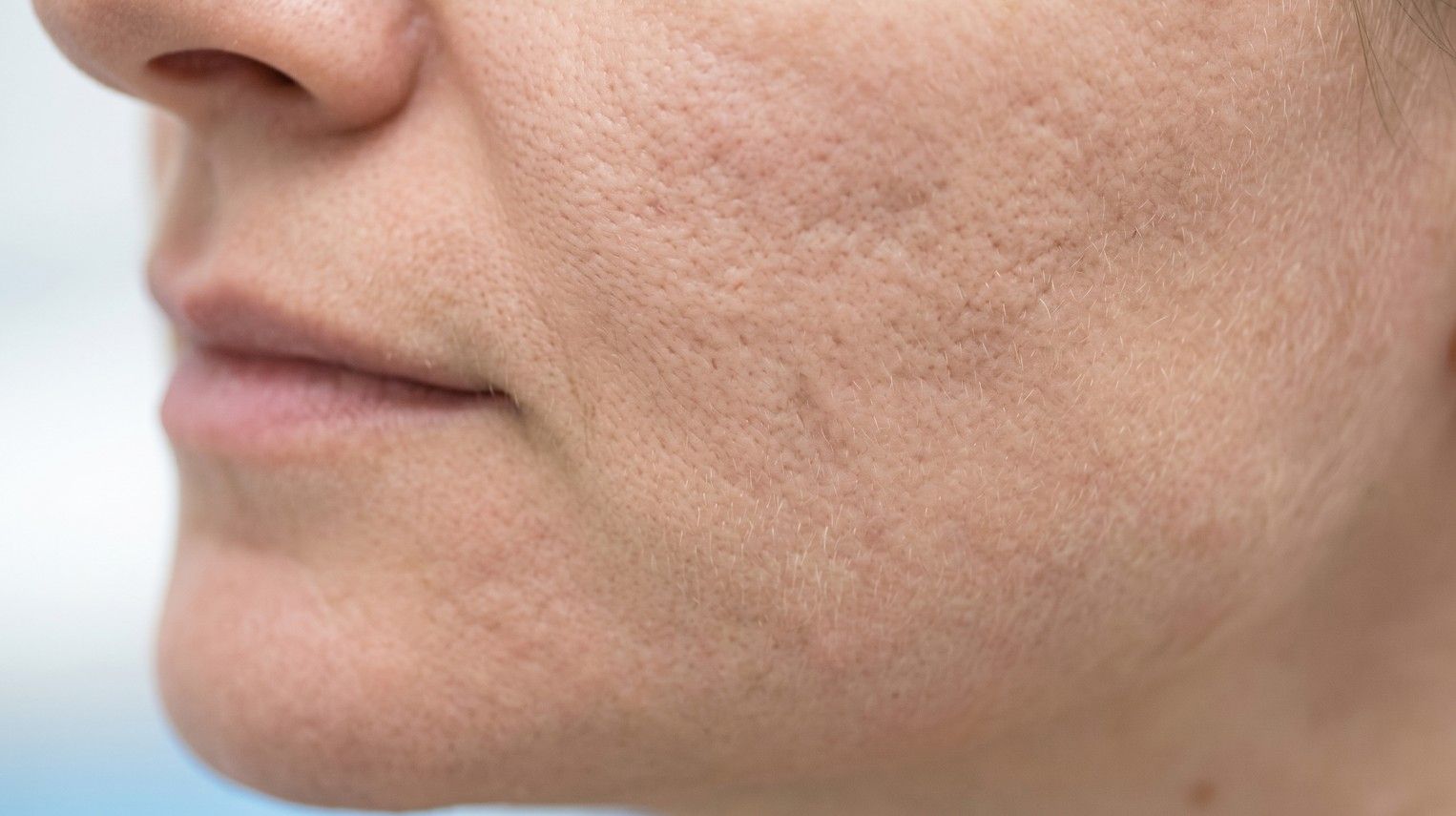 Close-up of skin showing subtle but visible acne scarring and textural irregularity on a cheek