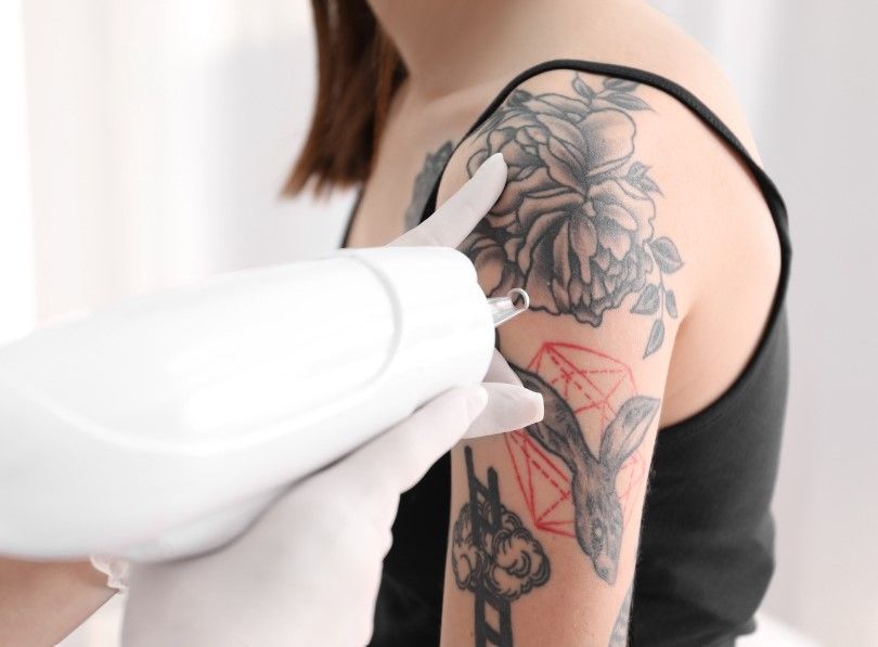 The Skinutrition Clinic performing  laser tattoo removal for a client in Coventry 