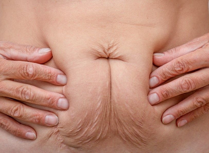 The Skinutrition Clinic before a non surgical tummy tuck in Coventry