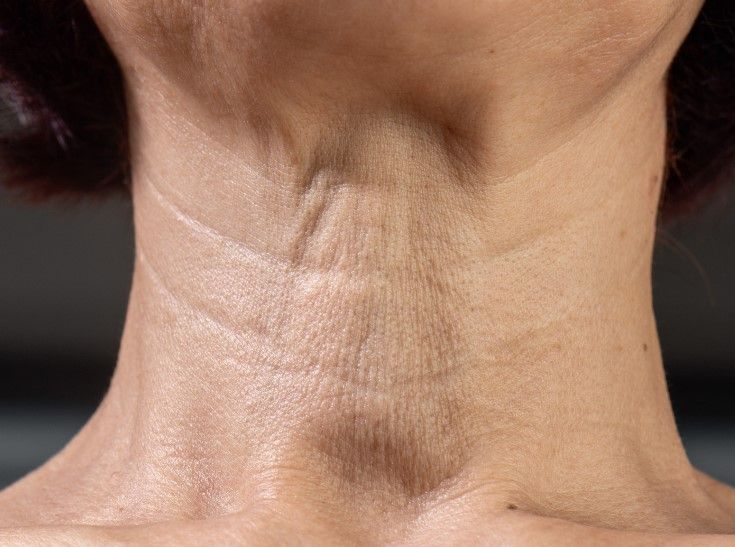 The Skinutrition Clinic before a neck lift is performed for sagging skin
