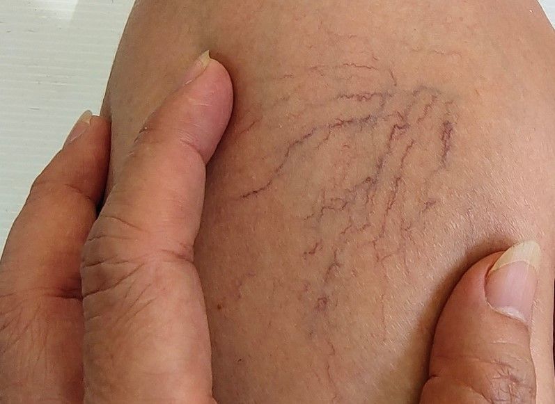Thread veins on a client's leg before treatment at The Skinutrition Clinic in Coventry