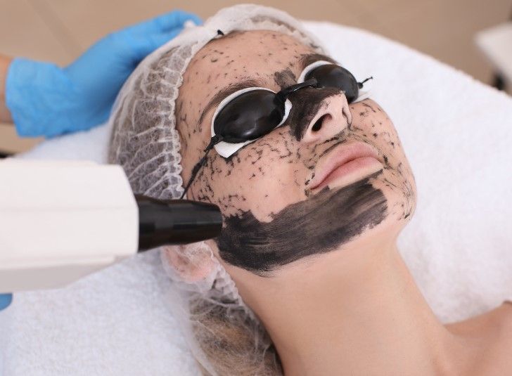 carbon laser facial at The Skinutrition Clinic Coventry 