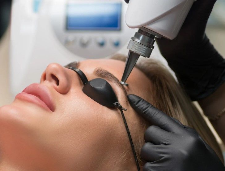 Laser removal of semi-permanent eyebrow make-up, with protective eye shields, at The Skinutrition Clinic in Coventry