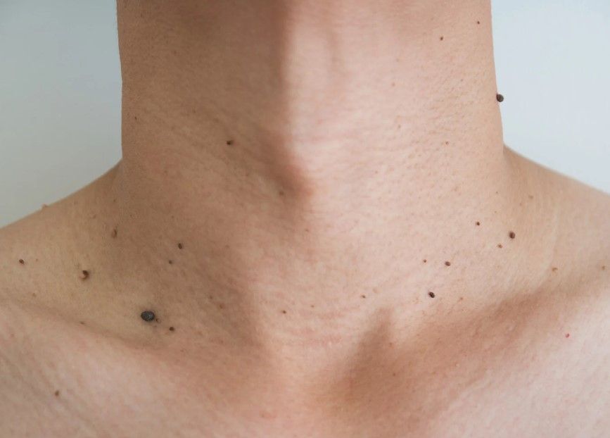 Several small skin tags on a client's neck and chest before removal at The Skinutrition Clinic in Coventry