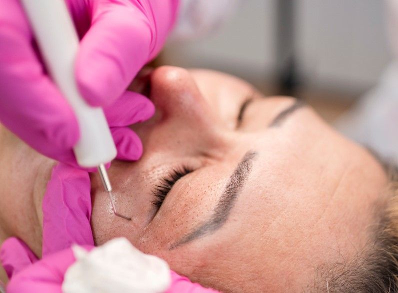 Plasma skin tightening treatment around the eye at The Skinutrition Clinic in Coventry