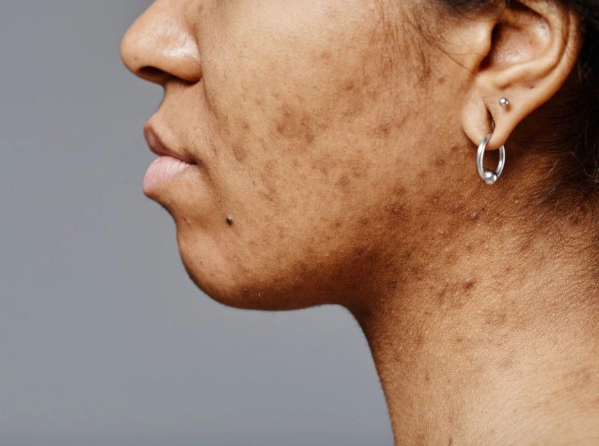 client with facial patchy hyperpigmentation