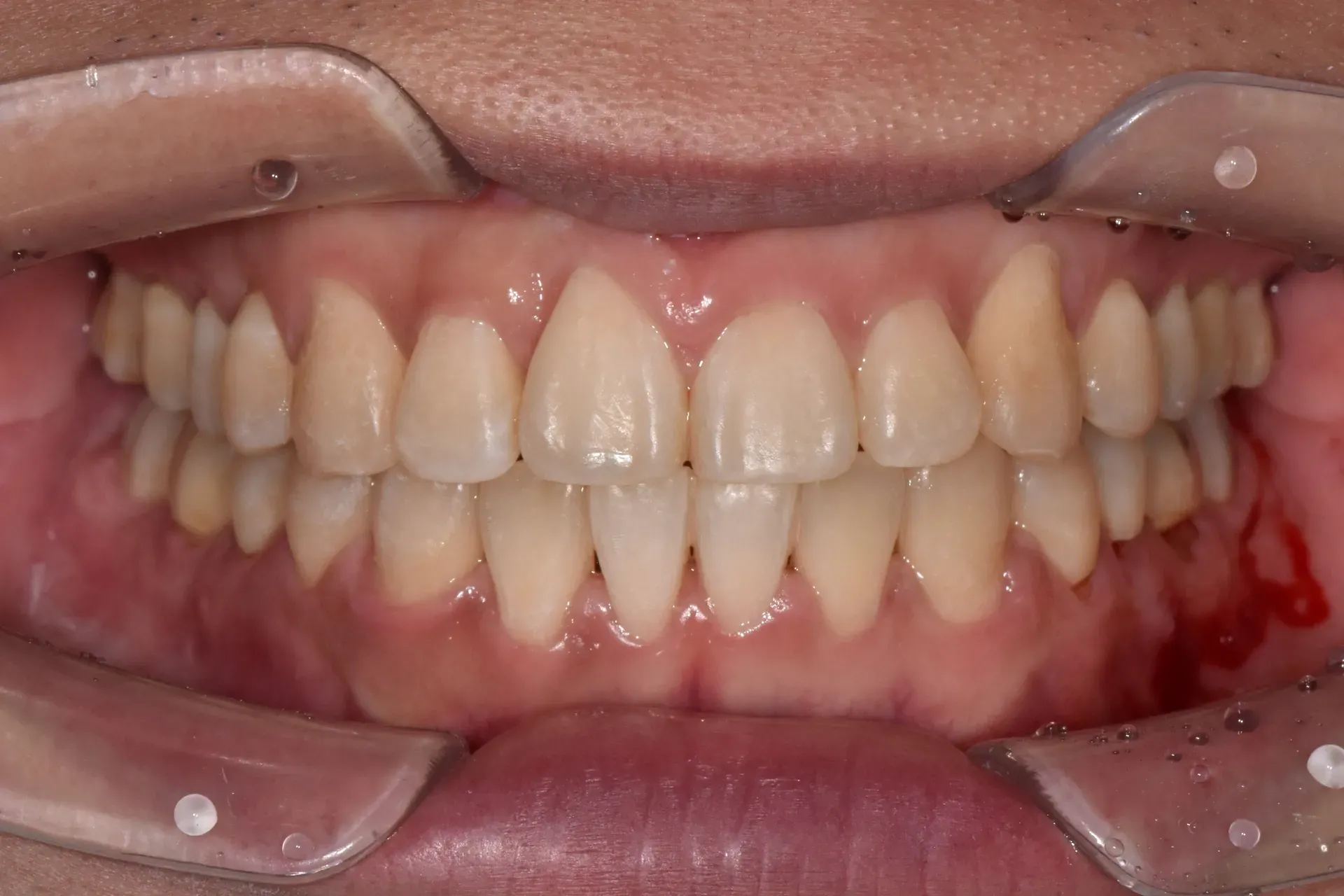 Case 1 after 20 months of Invisalign: front teeth aligned without extractions