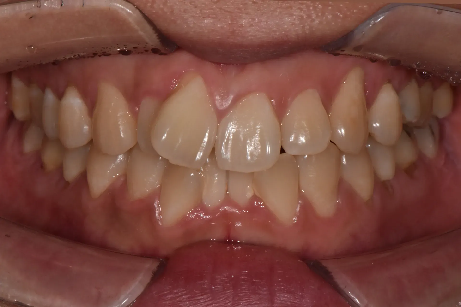 Case 1 before Invisalign: adult with crowded, overlapping front teeth and one upper front tooth sticking out