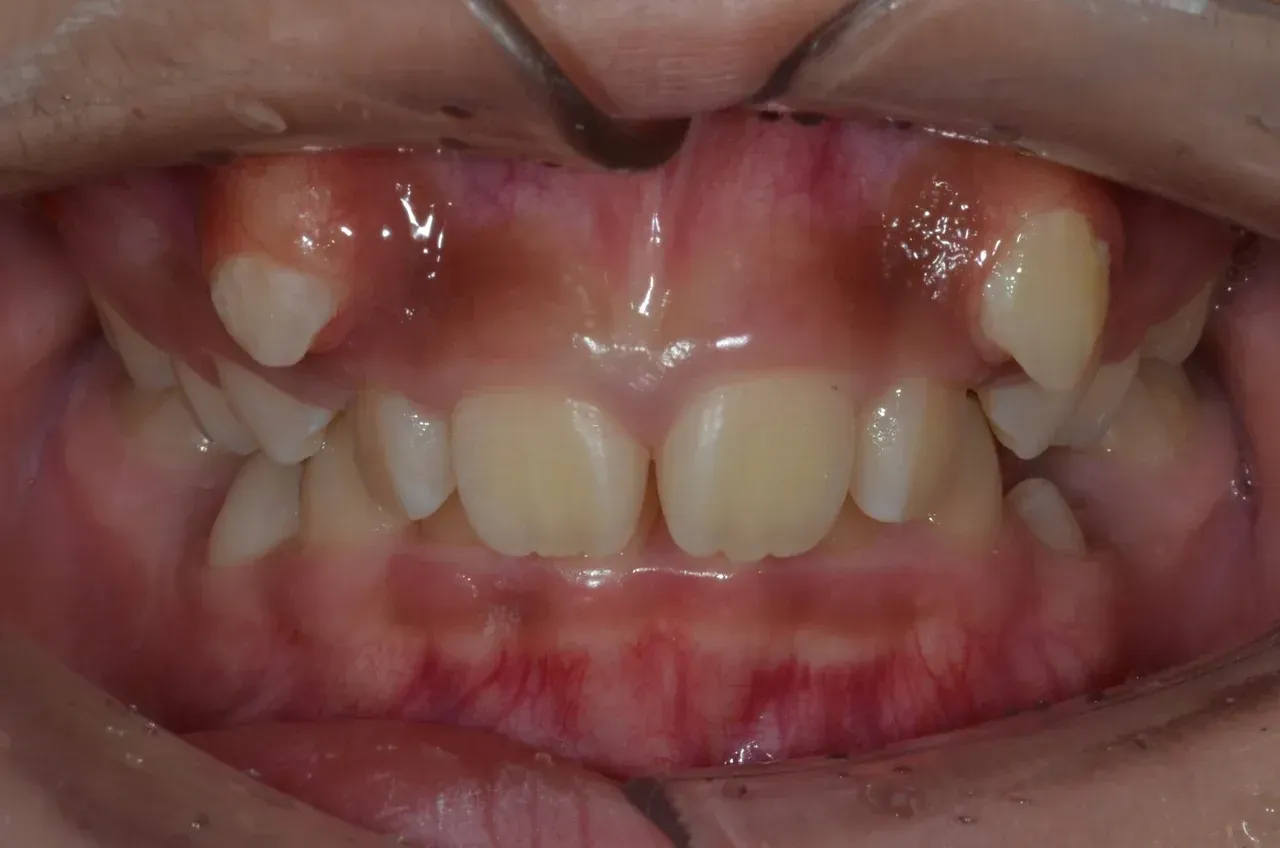 Case 3 before braces: teen with both upper canines erupted high and outside the arch and a severe deep bite