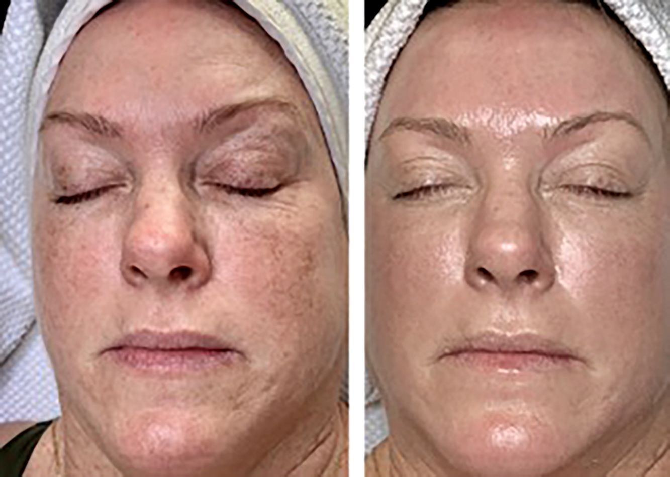 Side-by-side close-up of a woman’s face before and after skincare treatment, showing reduced redness and smoother skin.