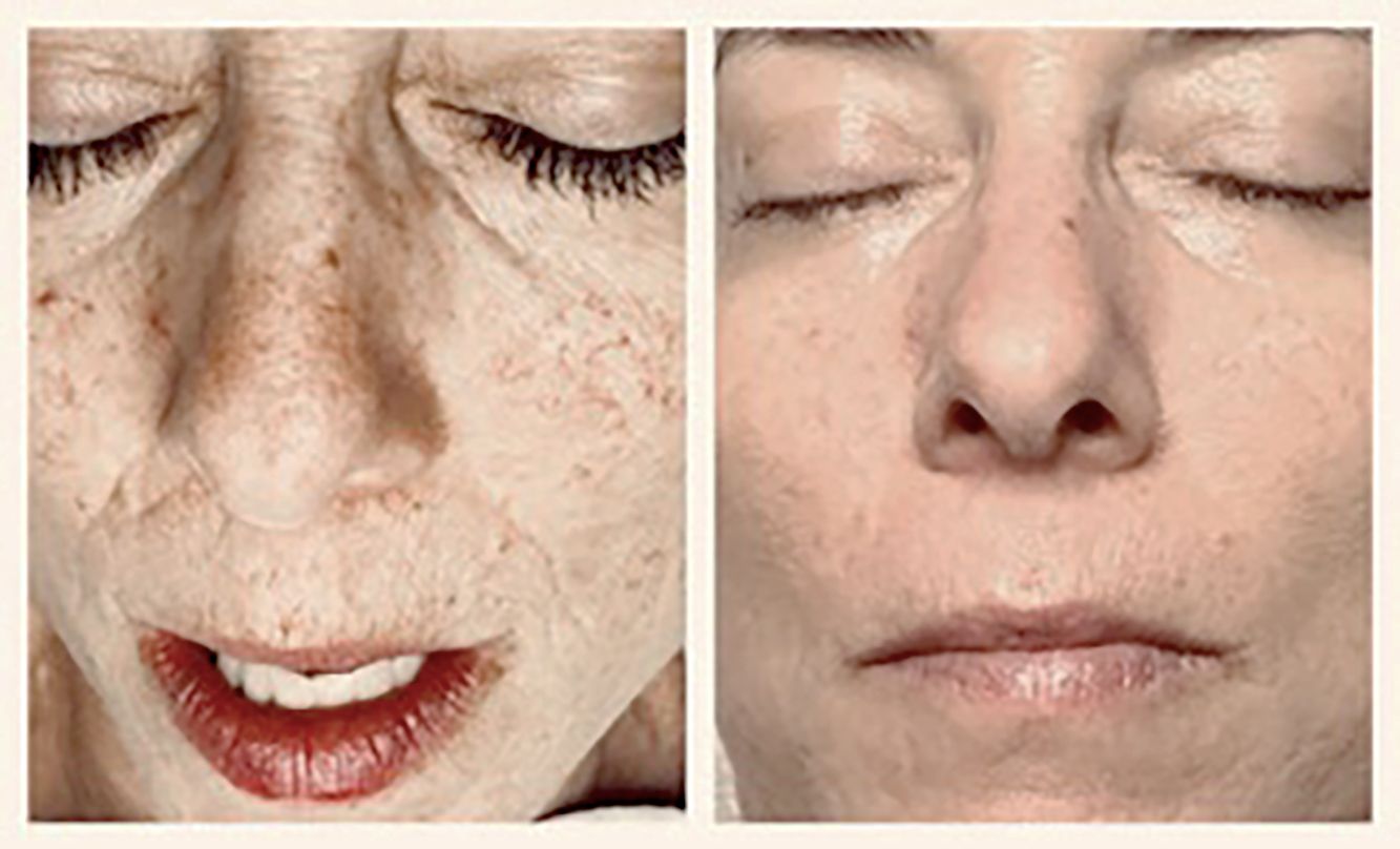 Close-up before-and-after faces showing textured, freckled skin on the left and smoother skin on the right.