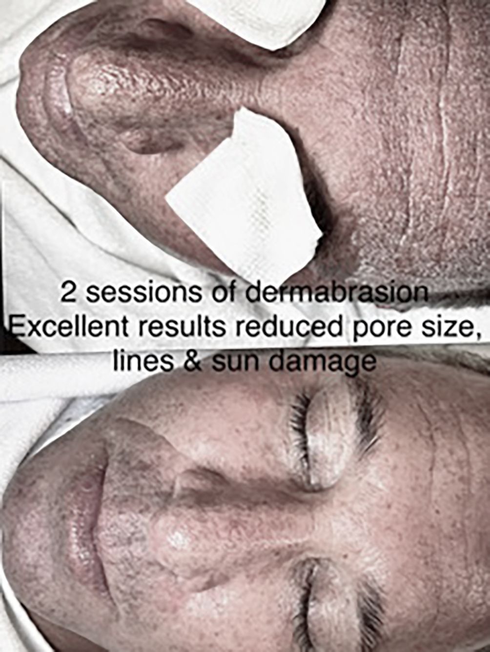 Before-and-after face photos with text: “2 sessions of dermabrasion,” showing reduced pore size and sun damage.