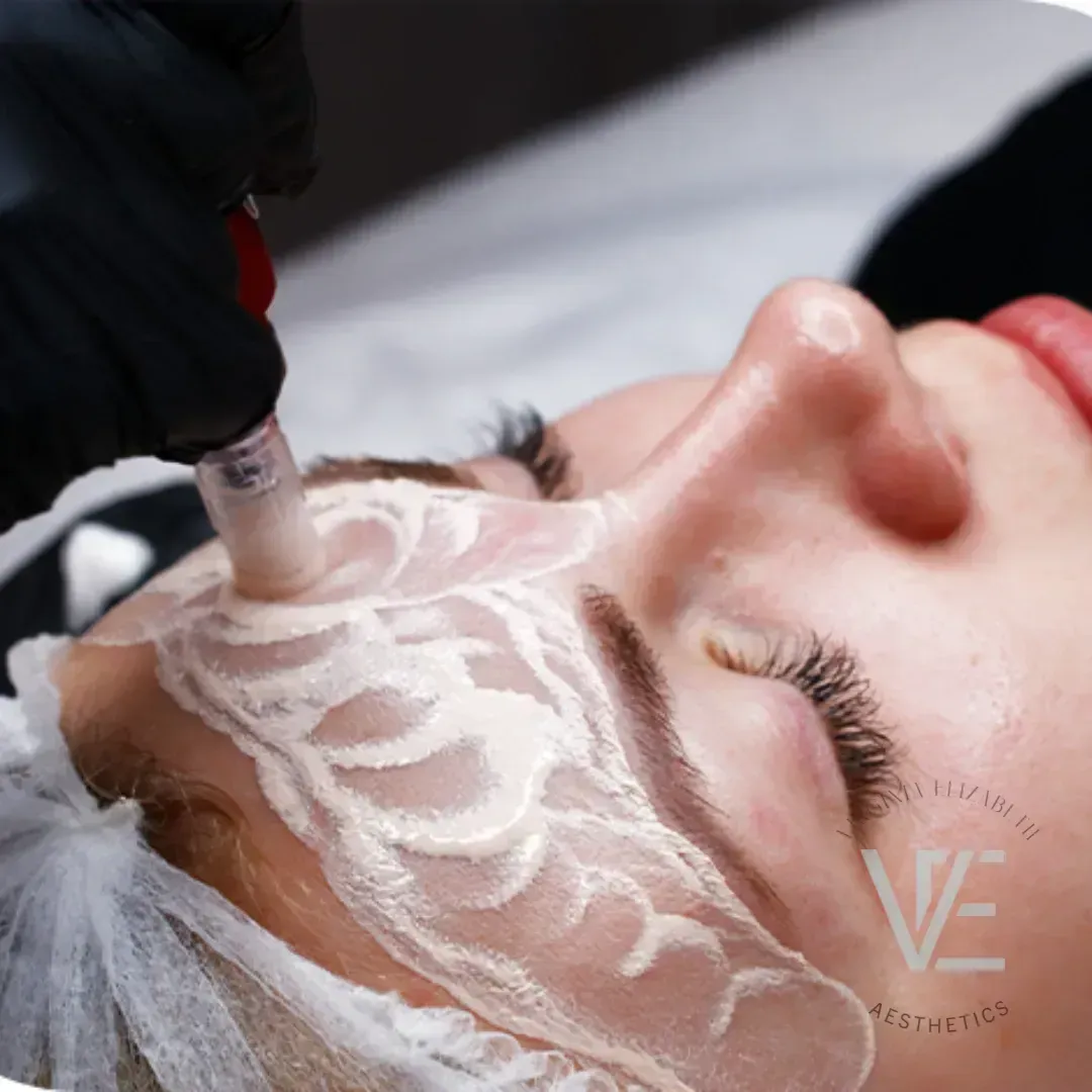 A professional cosmetic tool performs a microneedling treatment on a person's face covered in a white treatment serum.