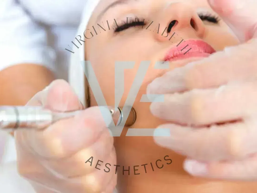 A professional aesthetician in gloves performing a microdermabrasion treatment on a client's cheek with a handheld device.