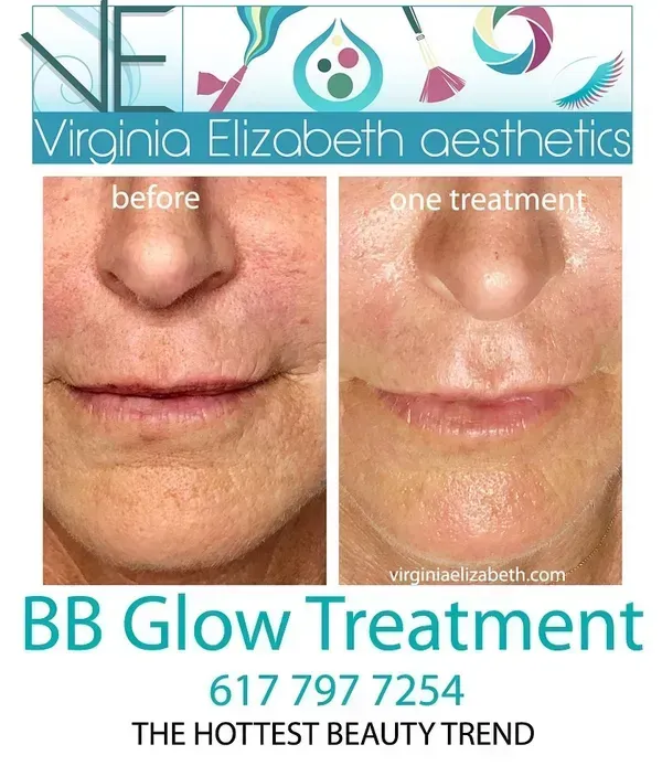 Before and after photos of a person's mouth and nose area showing the results of a BB Glow skin treatment.