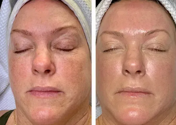 Before and after comparison of a person's face showing improved skin tone, texture, and reduced appearance of fine lines.