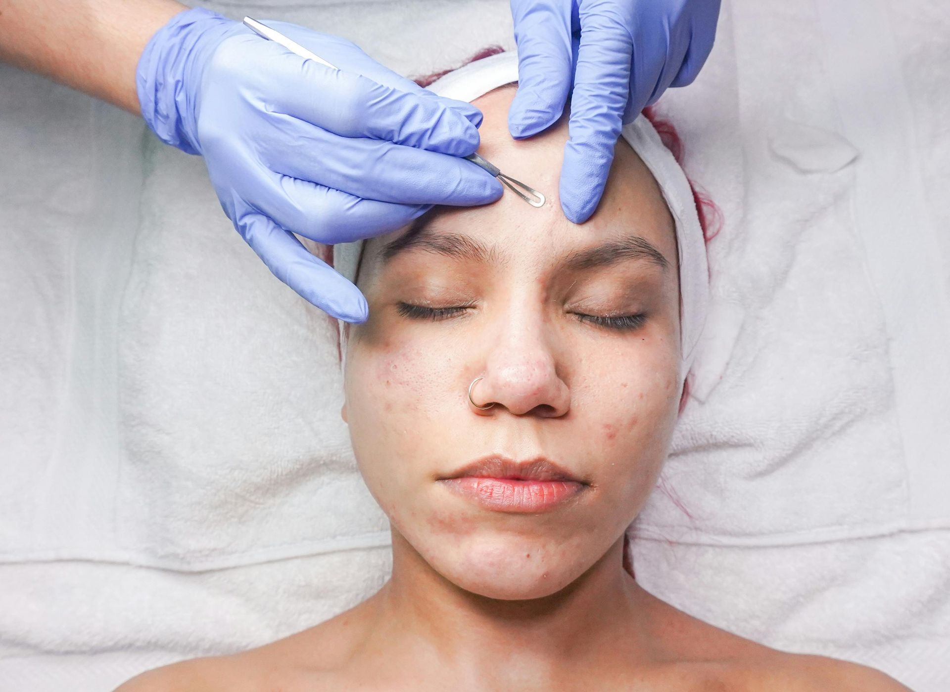 A person with a headband receives a professional facial extraction treatment on their forehead using a metal tool.
